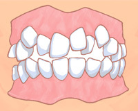 悪い歯並びとは？