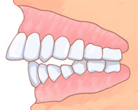 悪い歯並びとは？