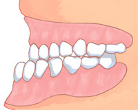 悪い歯並びとは？